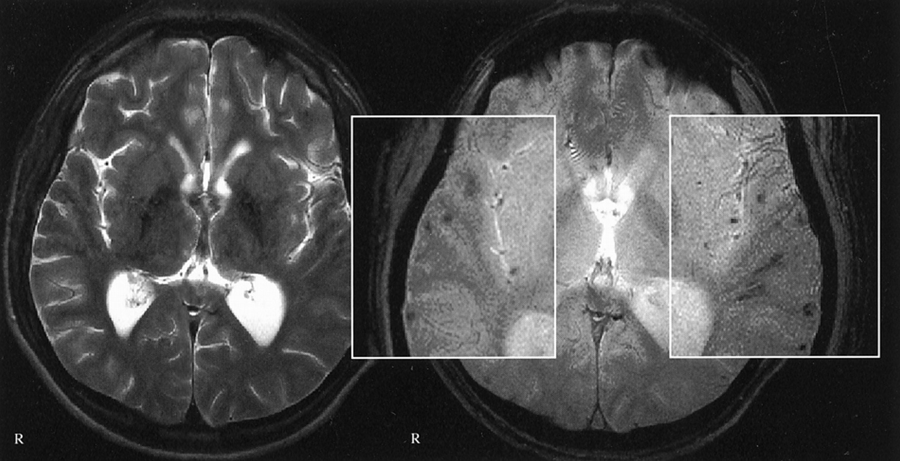 Detection of Traumatic Axonal Injury