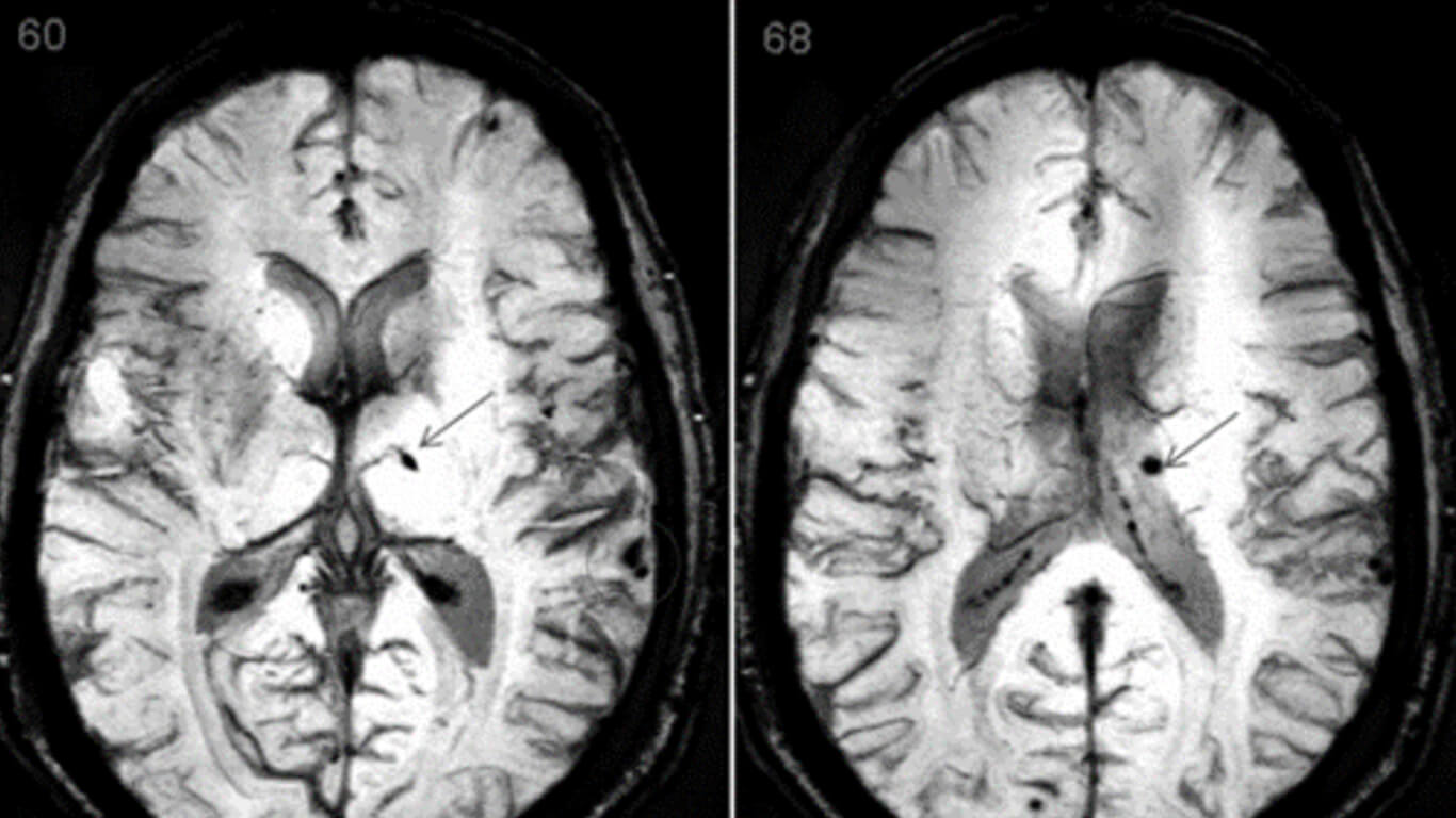 Detection of Traumatic Axonal Injury
