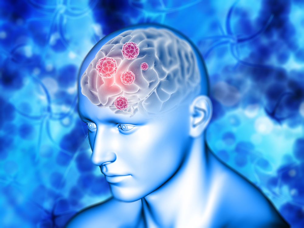 Neuroradiology Services for Seizures