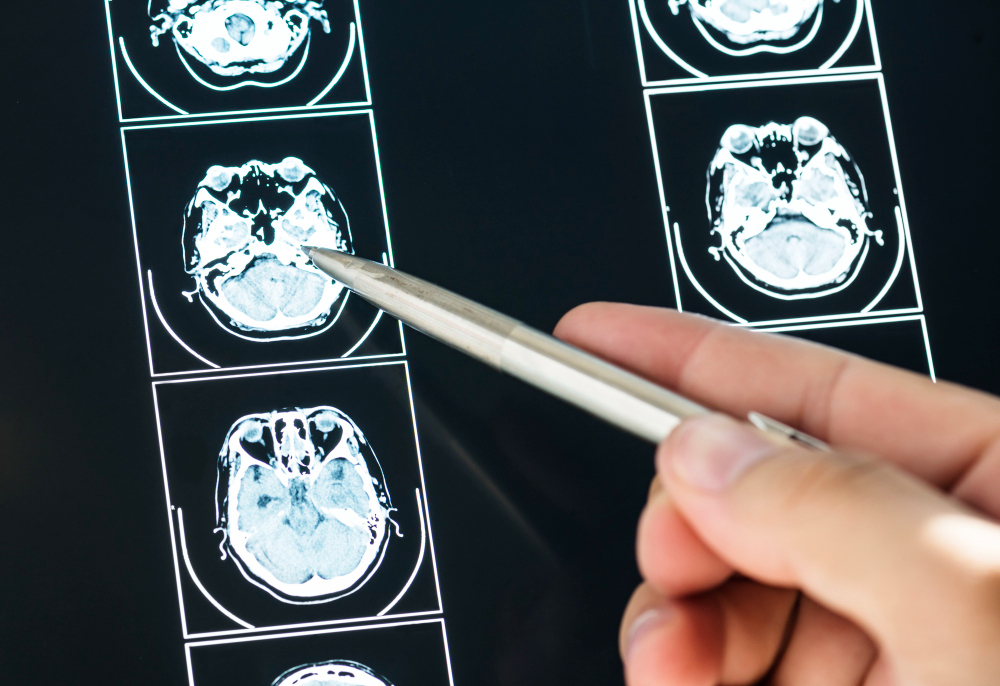 TBI Cases: Neuroscience Expert Witness Testimony